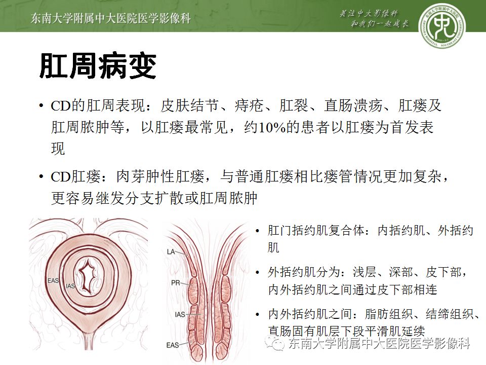 影像PPT - 【PPT】克罗恩病及常见并发症-18