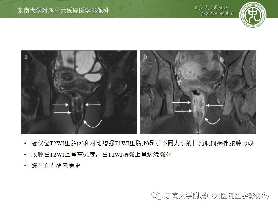 影像PPT - 【PPT】克罗恩病及常见并发症-21
