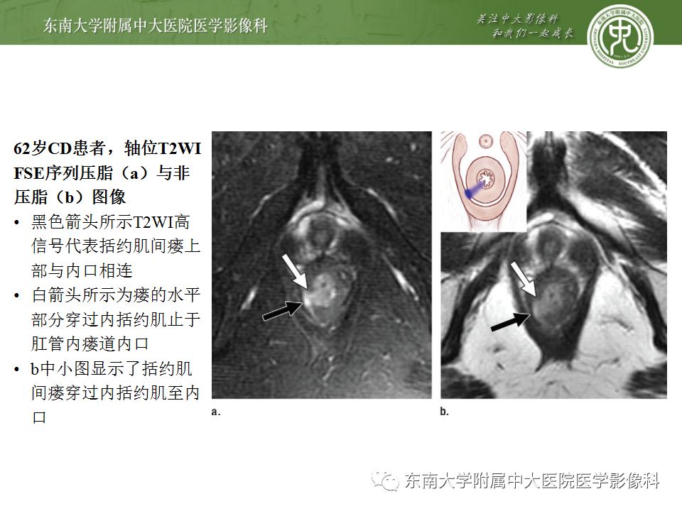 影像PPT - 【PPT】克罗恩病及常见并发症-22