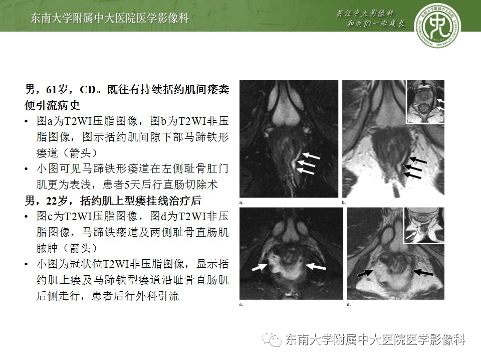 影像PPT - 【PPT】克罗恩病及常见并发症-23