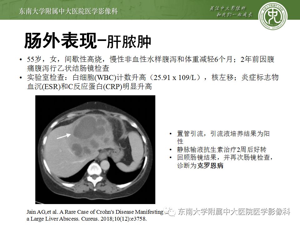 影像PPT - 【PPT】克罗恩病及常见并发症-28
