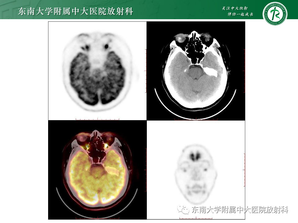 影像PPT - 【PPT】原发性葡萄膜黑色素瘤-4 影像PPT - 【PPT】原发性葡萄膜黑色素瘤-4