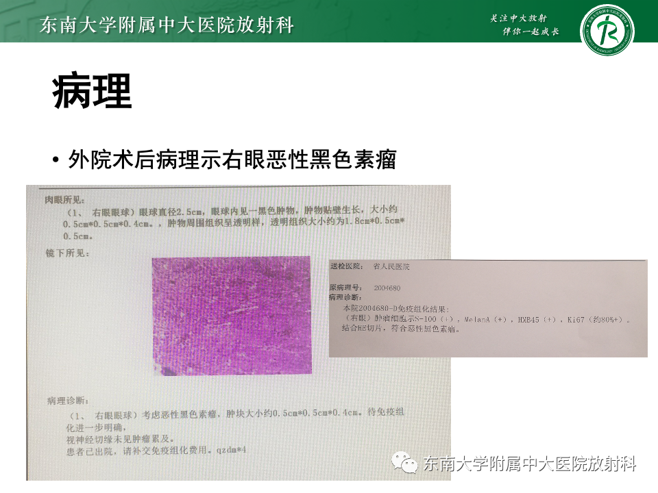 影像PPT - 【PPT】原发性葡萄膜黑色素瘤-5 影像PPT - 【PPT】原发性葡萄膜黑色素瘤-5