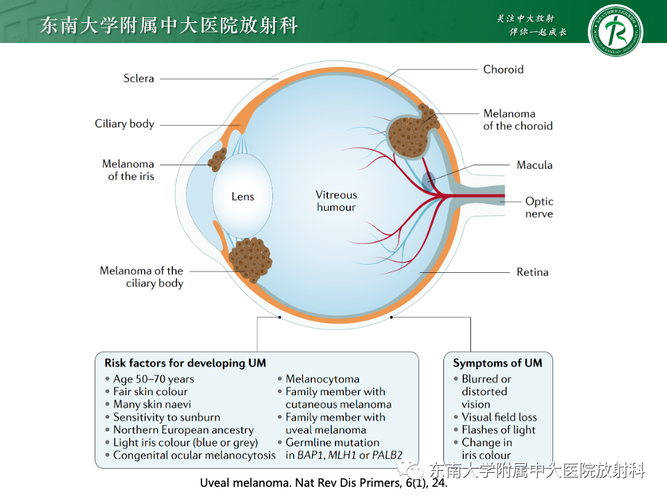 影像PPT - 【PPT】原发性葡萄膜黑色素瘤-8 影像PPT - 【PPT】原发性葡萄膜黑色素瘤-8