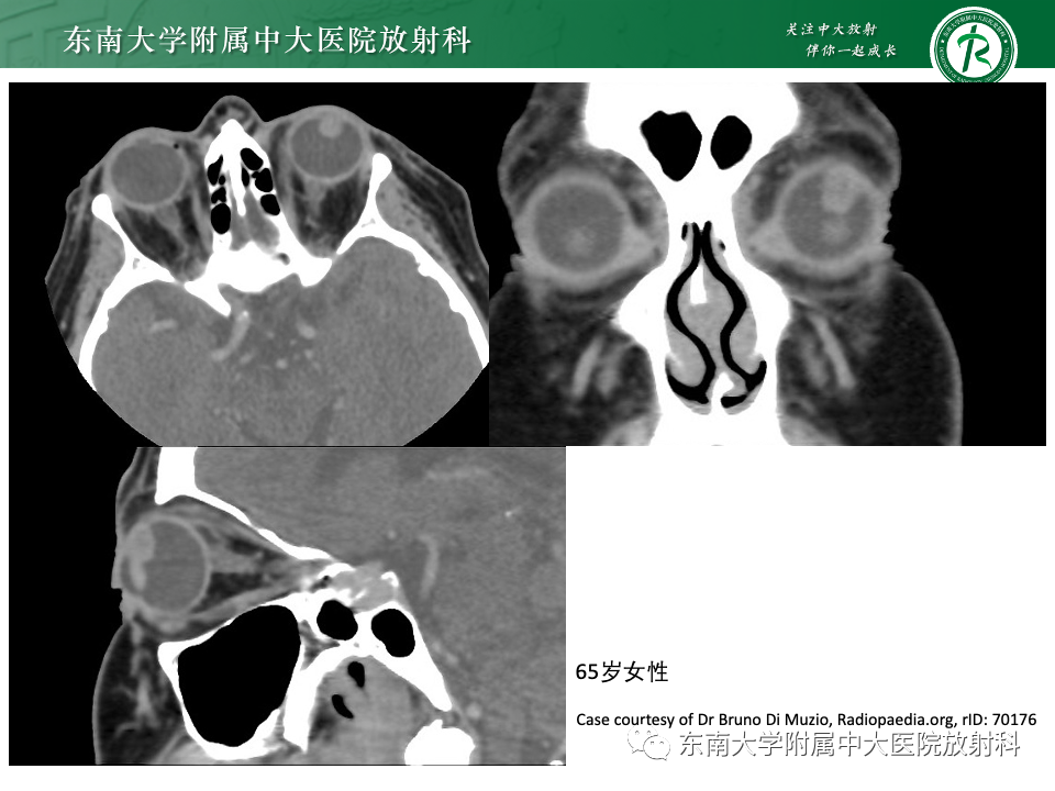 影像PPT - 【PPT】原发性葡萄膜黑色素瘤-12 影像PPT - 【PPT】原发性葡萄膜黑色素瘤-12