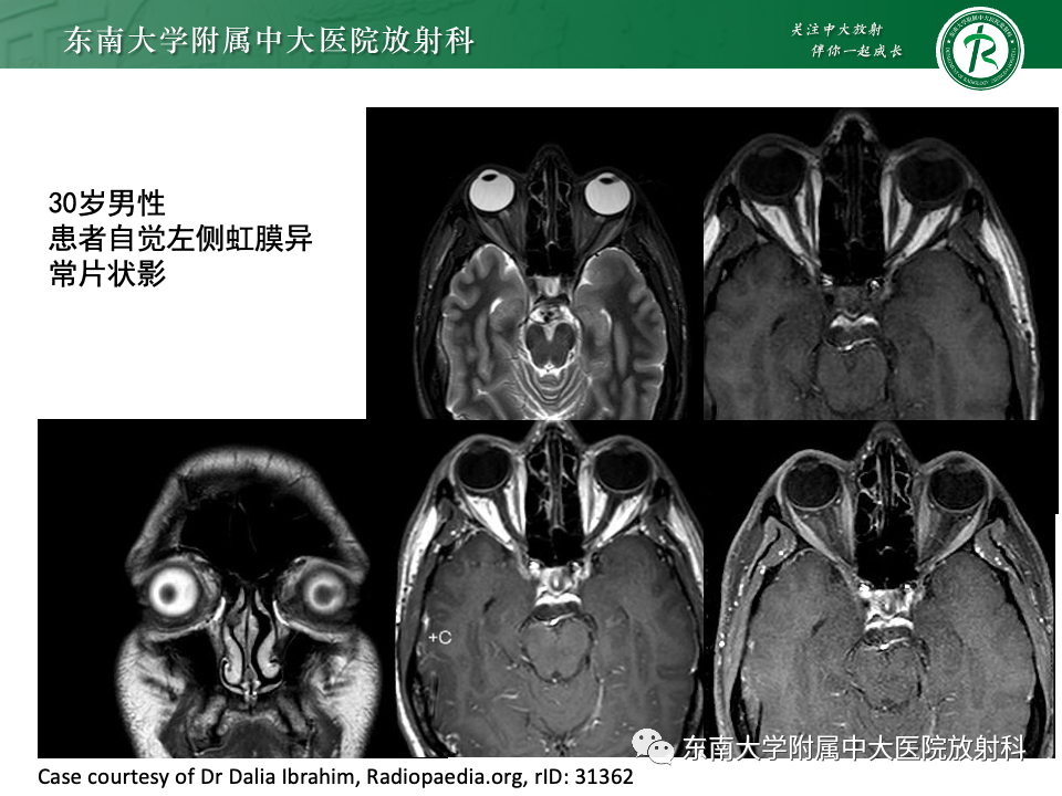 影像PPT - 【PPT】原发性葡萄膜黑色素瘤-15 影像PPT - 【PPT】原发性葡萄膜黑色素瘤-15