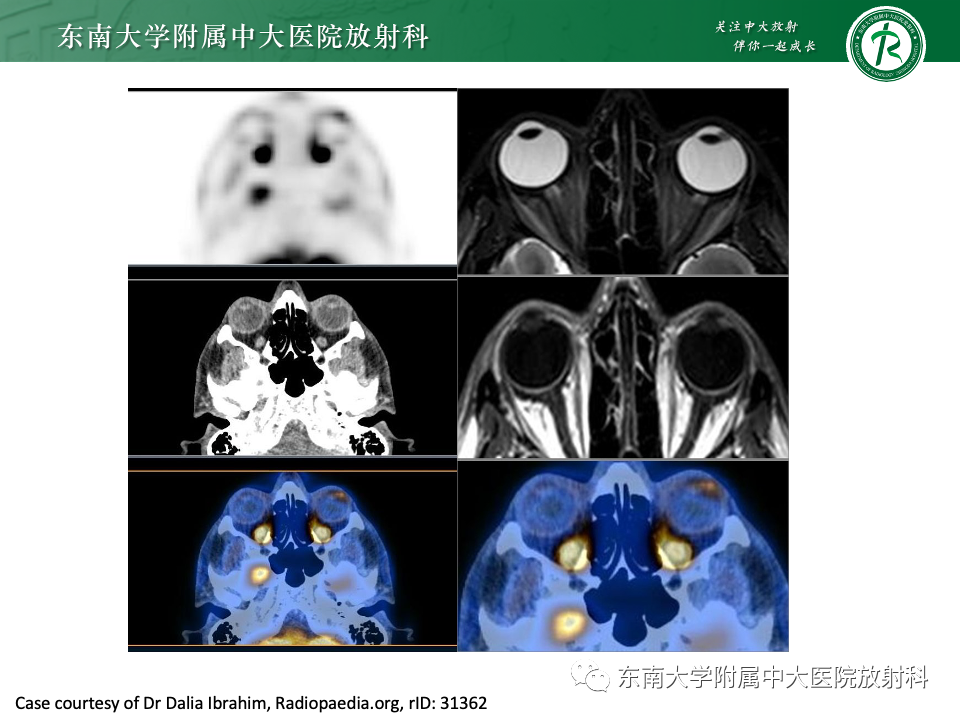 影像PPT - 【PPT】原发性葡萄膜黑色素瘤-16 影像PPT - 【PPT】原发性葡萄膜黑色素瘤-16