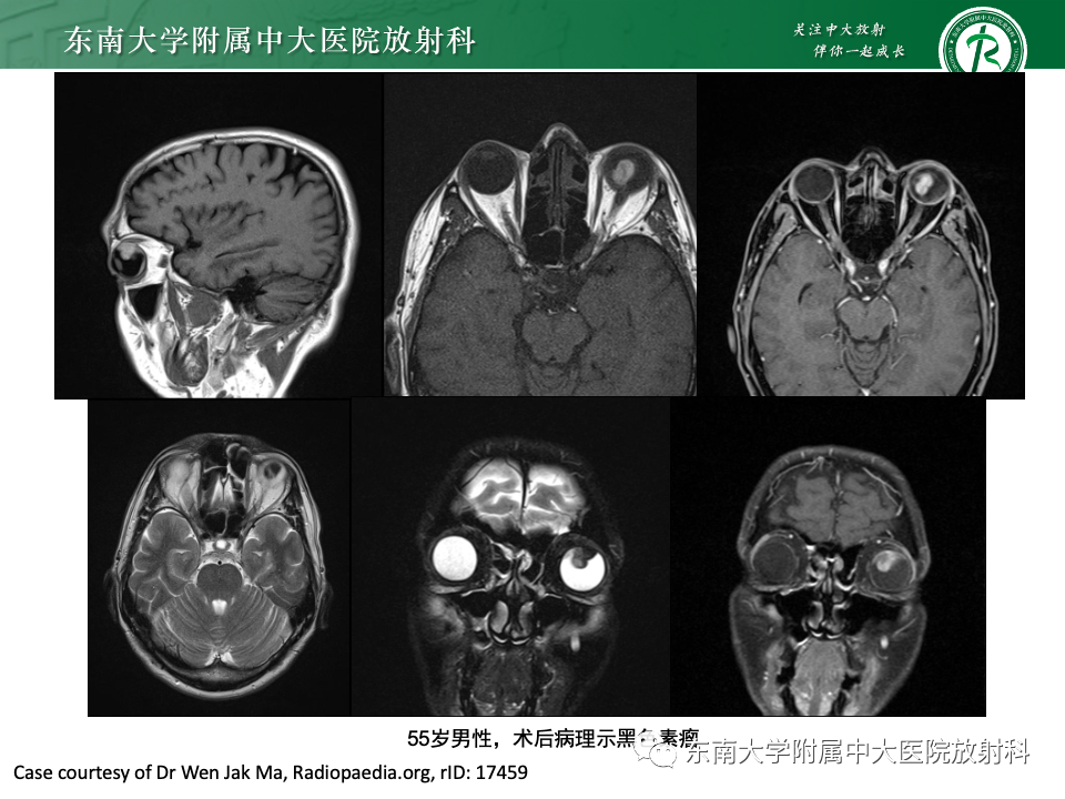 影像PPT - 【PPT】原发性葡萄膜黑色素瘤-14 影像PPT - 【PPT】原发性葡萄膜黑色素瘤-14