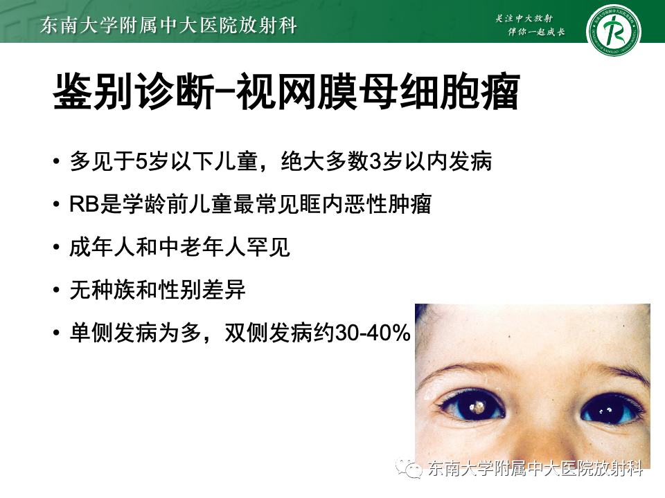 影像PPT - 【PPT】原发性葡萄膜黑色素瘤-17 影像PPT - 【PPT】原发性葡萄膜黑色素瘤-17