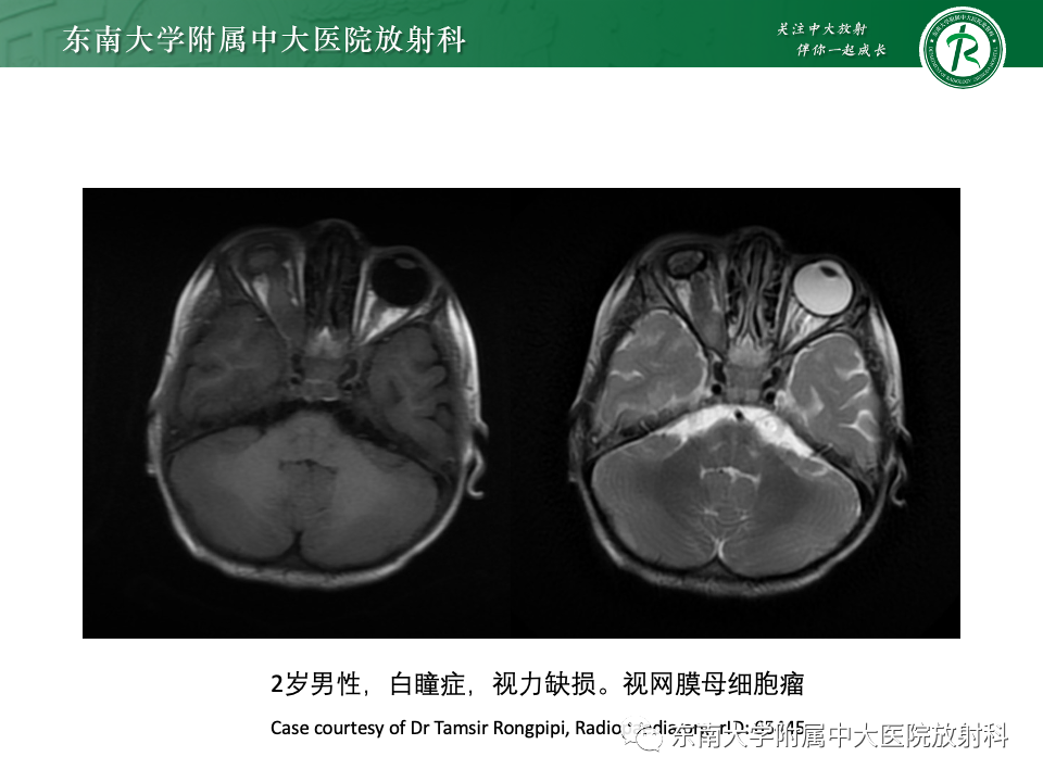 影像PPT - 【PPT】原发性葡萄膜黑色素瘤-21 影像PPT - 【PPT】原发性葡萄膜黑色素瘤-21