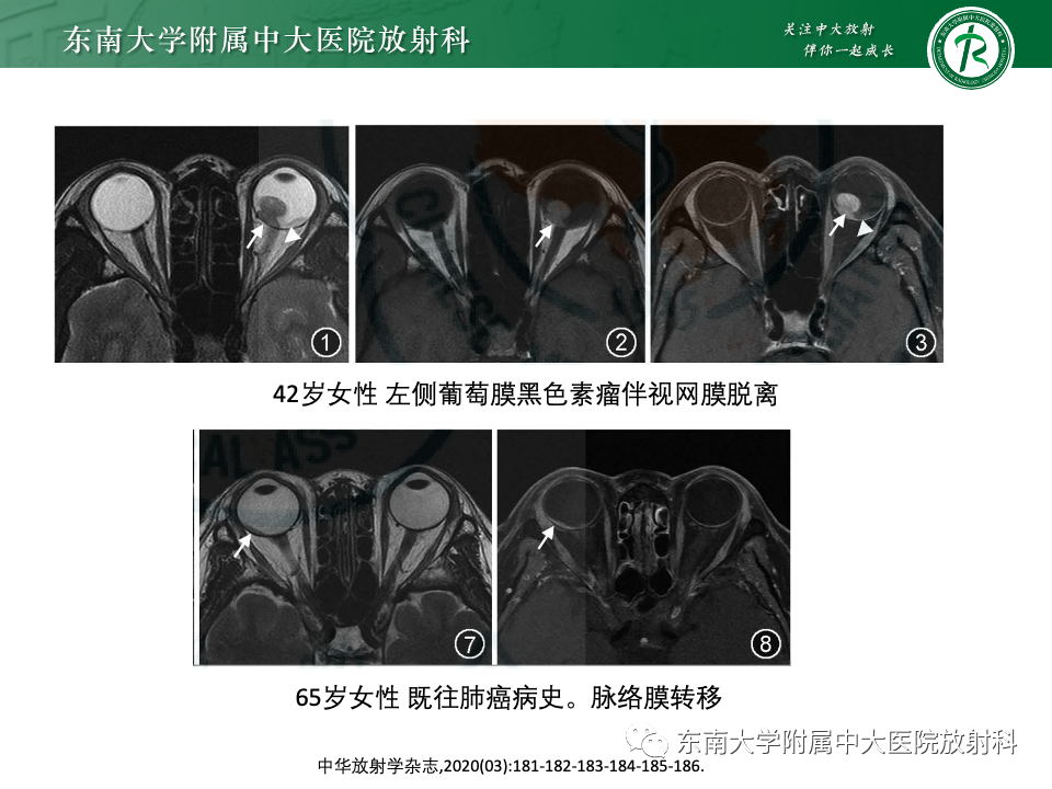 影像PPT - 【PPT】原发性葡萄膜黑色素瘤-23 影像PPT - 【PPT】原发性葡萄膜黑色素瘤-23