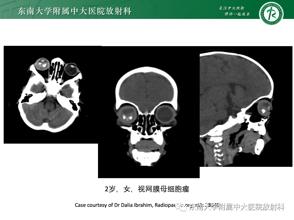 影像PPT - 【PPT】原发性葡萄膜黑色素瘤-19 影像PPT - 【PPT】原发性葡萄膜黑色素瘤-19