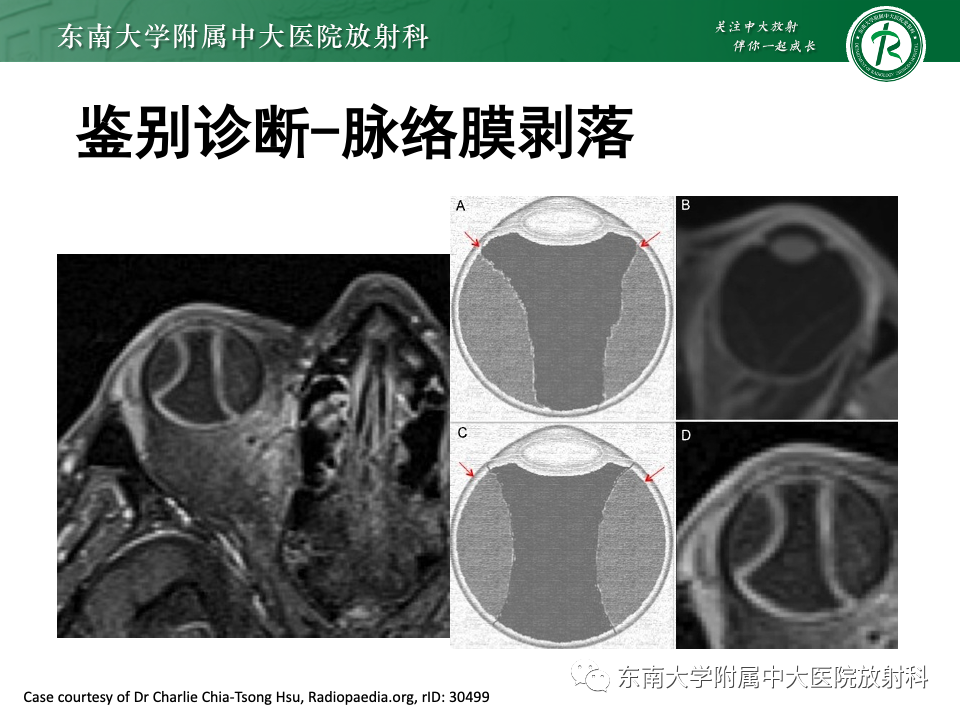 影像PPT - 【PPT】原发性葡萄膜黑色素瘤-26 影像PPT - 【PPT】原发性葡萄膜黑色素瘤-26