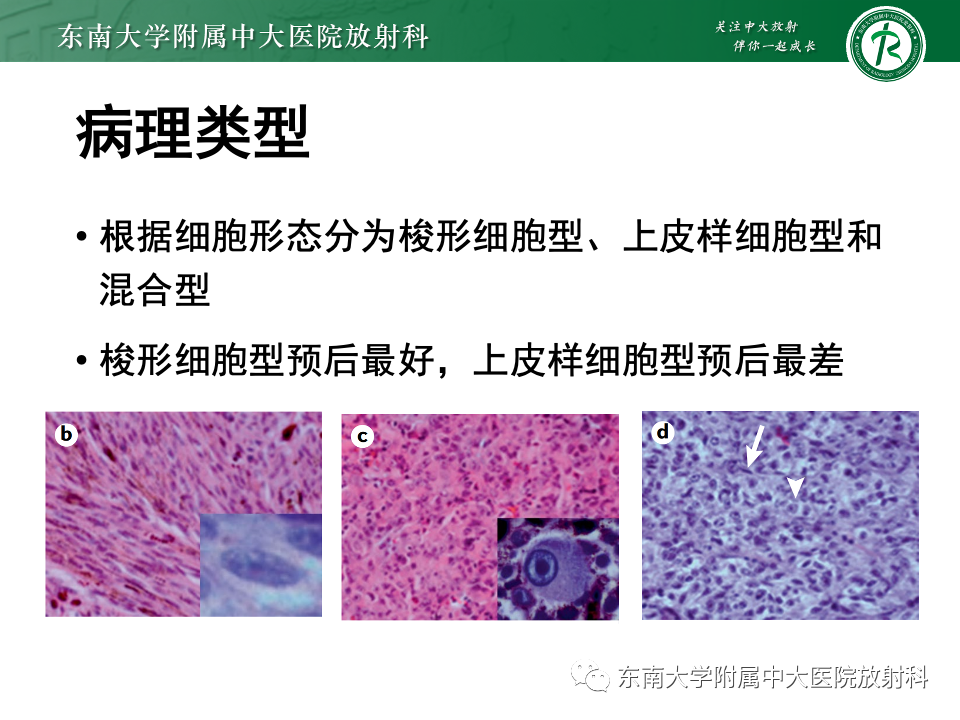 影像PPT - 【PPT】原发性葡萄膜黑色素瘤-27 影像PPT - 【PPT】原发性葡萄膜黑色素瘤-27