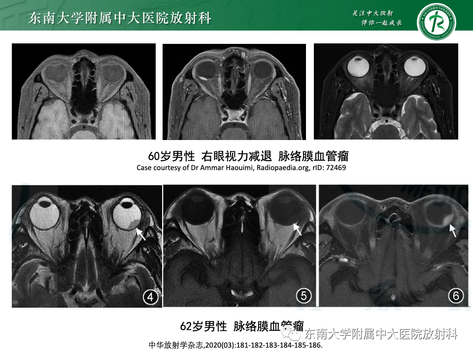 影像PPT - 【PPT】原发性葡萄膜黑色素瘤-25 影像PPT - 【PPT】原发性葡萄膜黑色素瘤-25