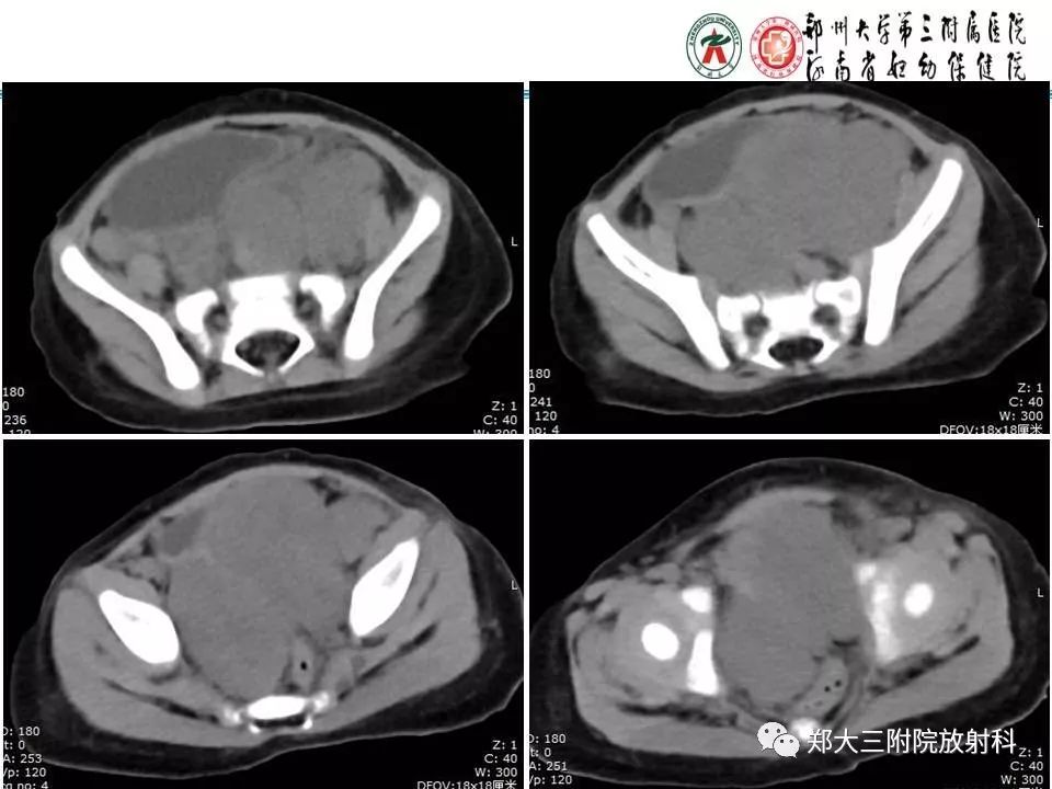 影像PPT - 【PPT】儿童腹盆腔横纹肌肉瘤病例分享-3