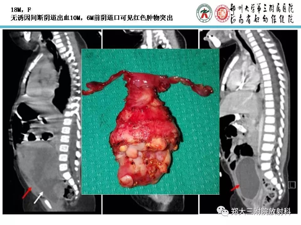 影像PPT - 【PPT】儿童腹盆腔横纹肌肉瘤病例分享-17