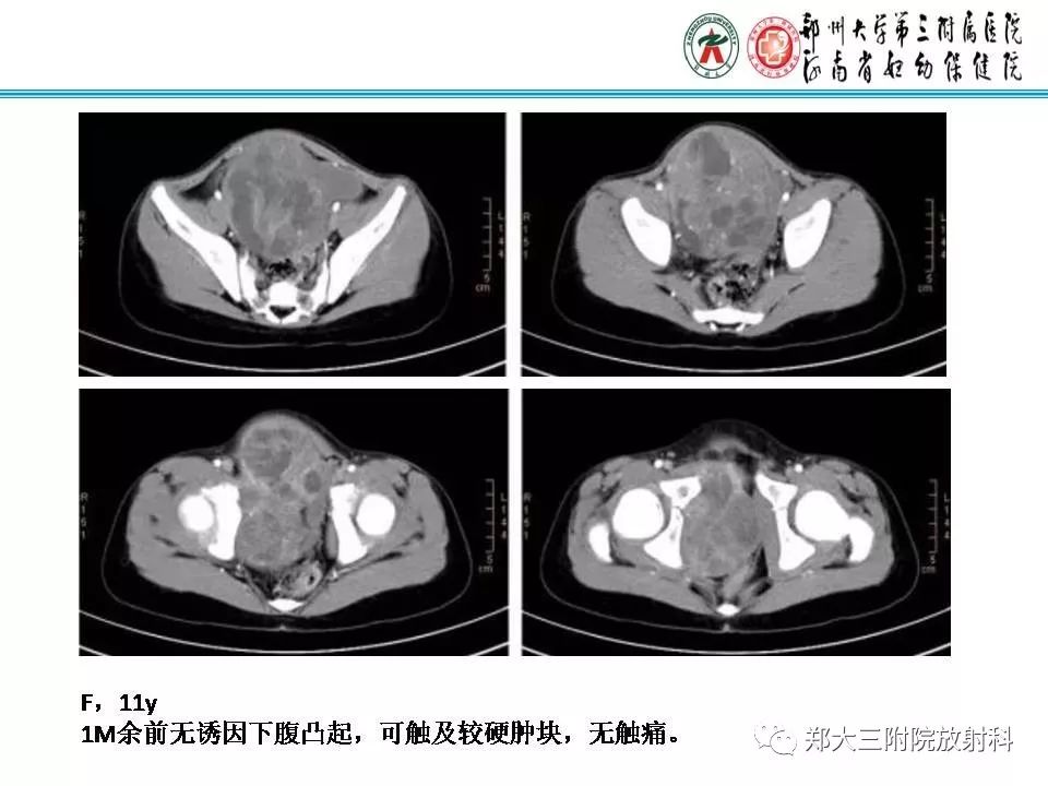 影像PPT - 【PPT】儿童腹盆腔横纹肌肉瘤病例分享-16