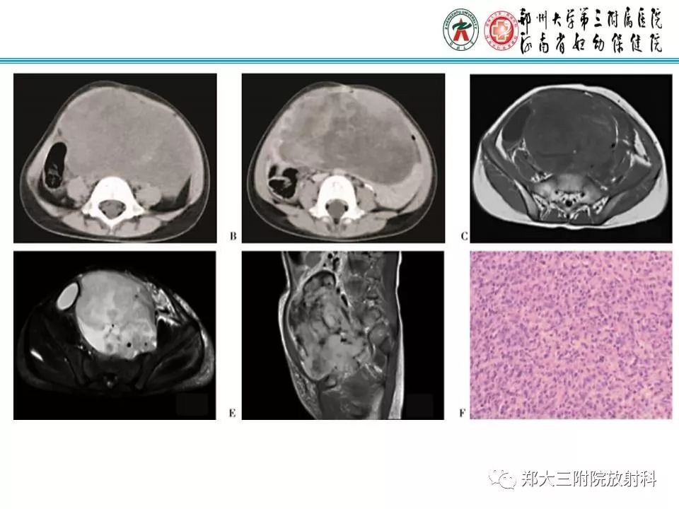 影像PPT - 【PPT】儿童腹盆腔横纹肌肉瘤病例分享-18