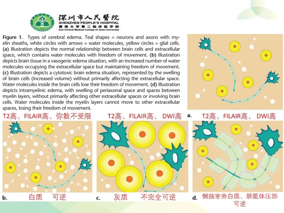 影像PPT - 【PPT】中毒性和代谢性脑病的显像模式-4