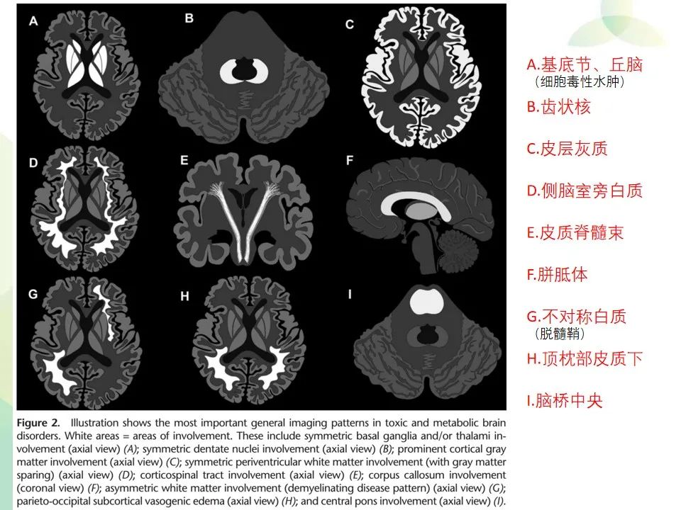 影像PPT - 【PPT】中毒性和代谢性脑病的显像模式-6