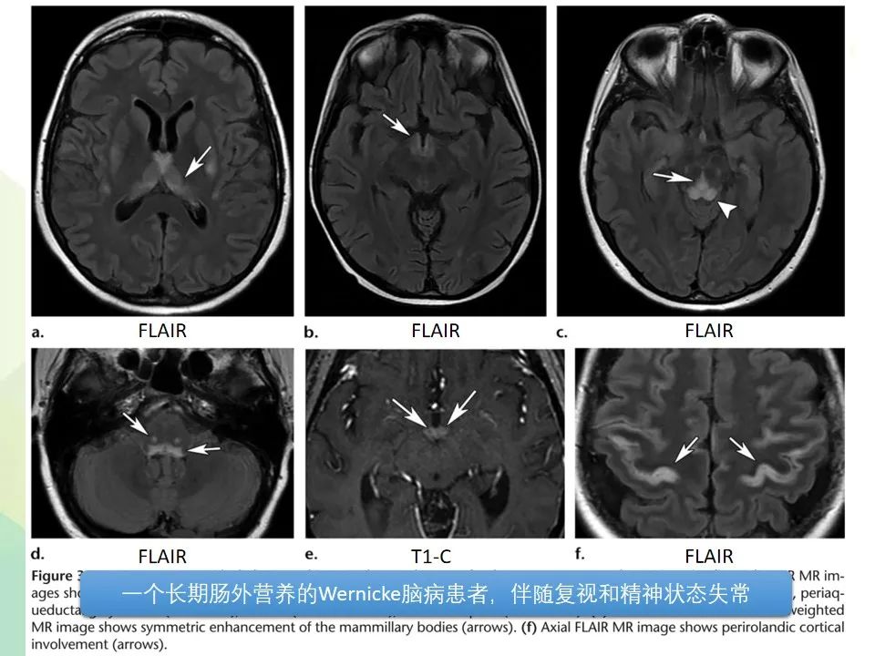 影像PPT - 【PPT】中毒性和代谢性脑病的显像模式-8