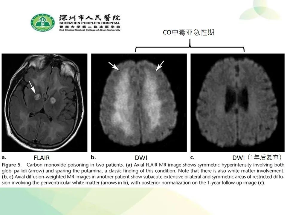 影像PPT - 【PPT】中毒性和代谢性脑病的显像模式-12