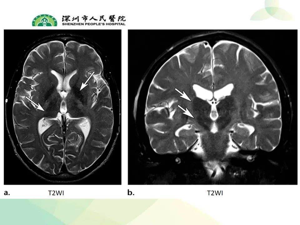 影像PPT - 【PPT】中毒性和代谢性脑病的显像模式-18