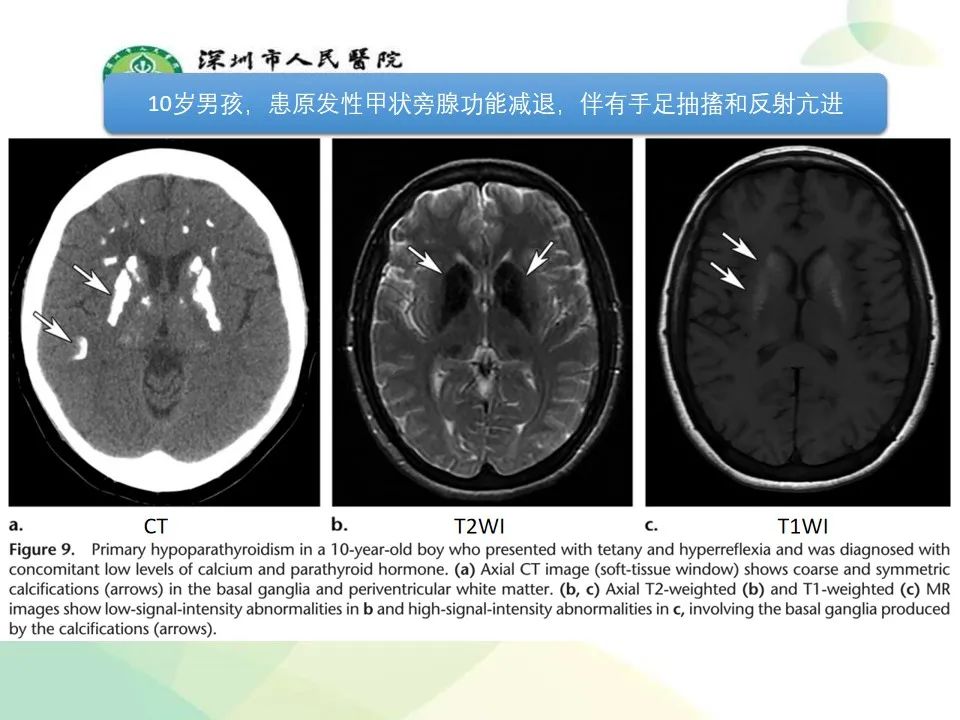 影像PPT - 【PPT】中毒性和代谢性脑病的显像模式-20