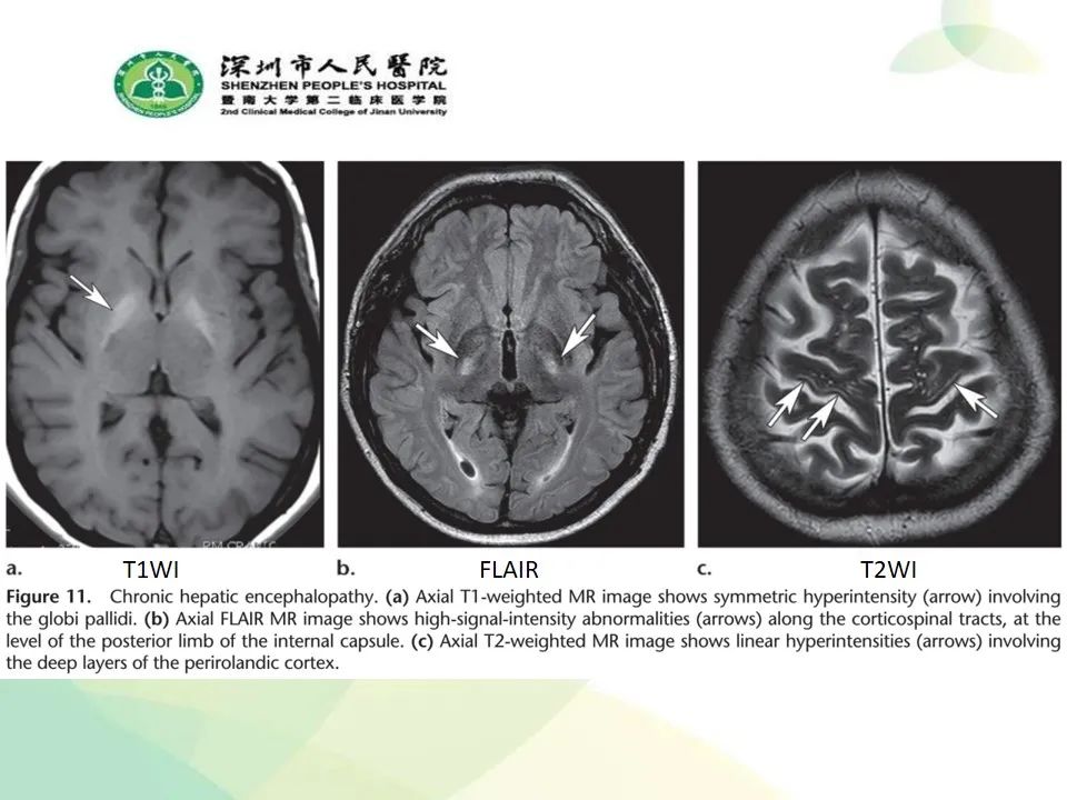 影像PPT - 【PPT】中毒性和代谢性脑病的显像模式-24