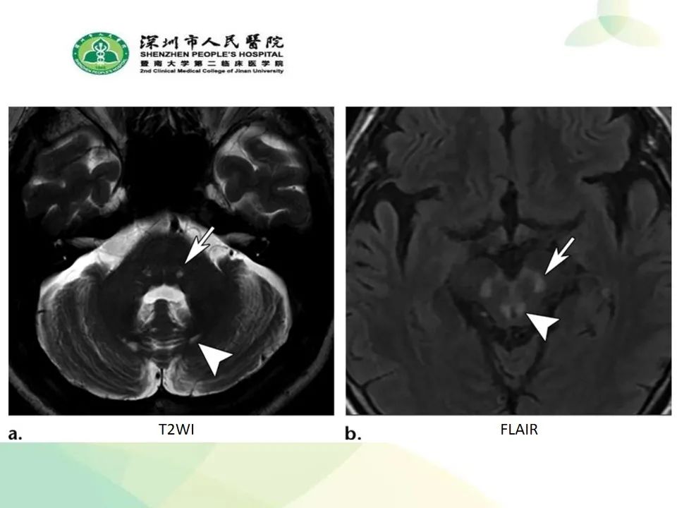 影像PPT - 【PPT】中毒性和代谢性脑病的显像模式-29