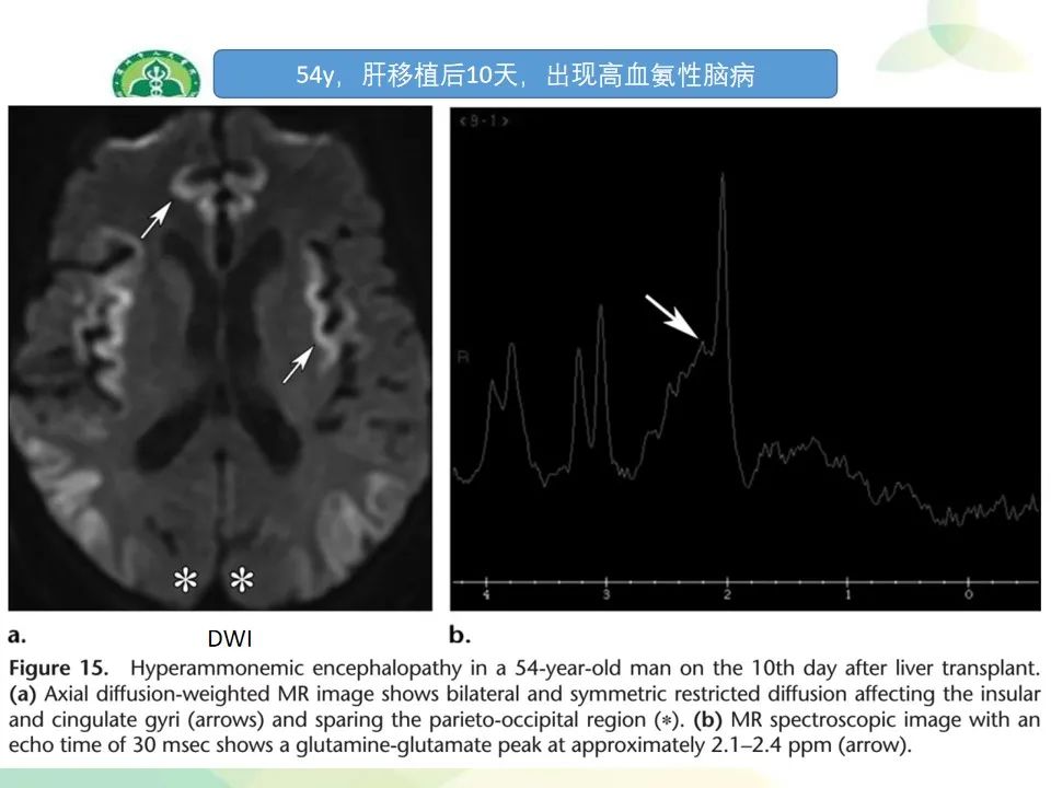 影像PPT - 【PPT】中毒性和代谢性脑病的显像模式-34