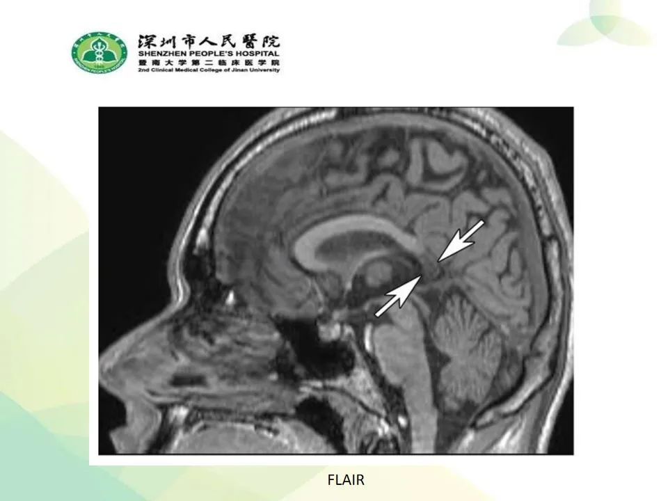 影像PPT - 【PPT】中毒性和代谢性脑病的显像模式-43