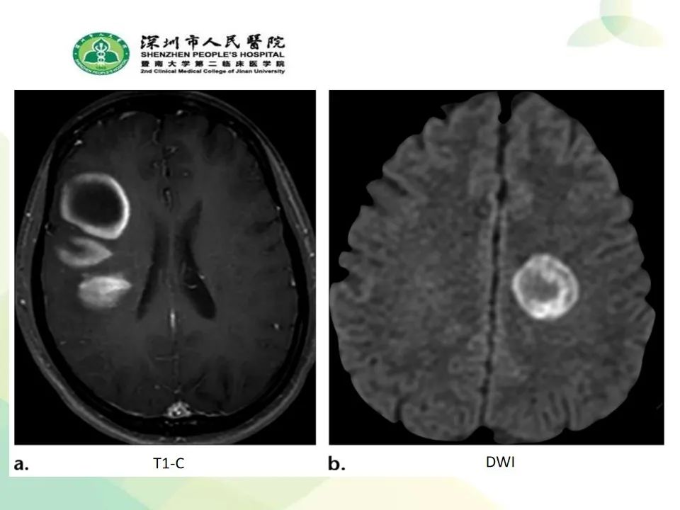 影像PPT - 【PPT】中毒性和代谢性脑病的显像模式-48