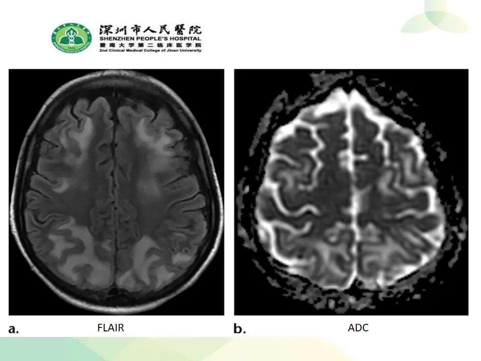 影像PPT - 【PPT】中毒性和代谢性脑病的显像模式-50