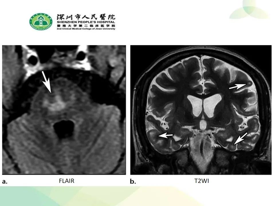 影像PPT - 【PPT】中毒性和代谢性脑病的显像模式-52