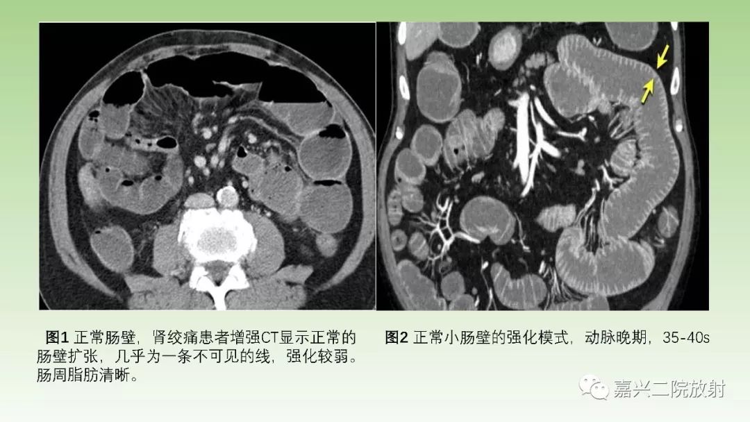 影像PPT - 【PPT】肠壁增厚的CT鉴别诊断-4
