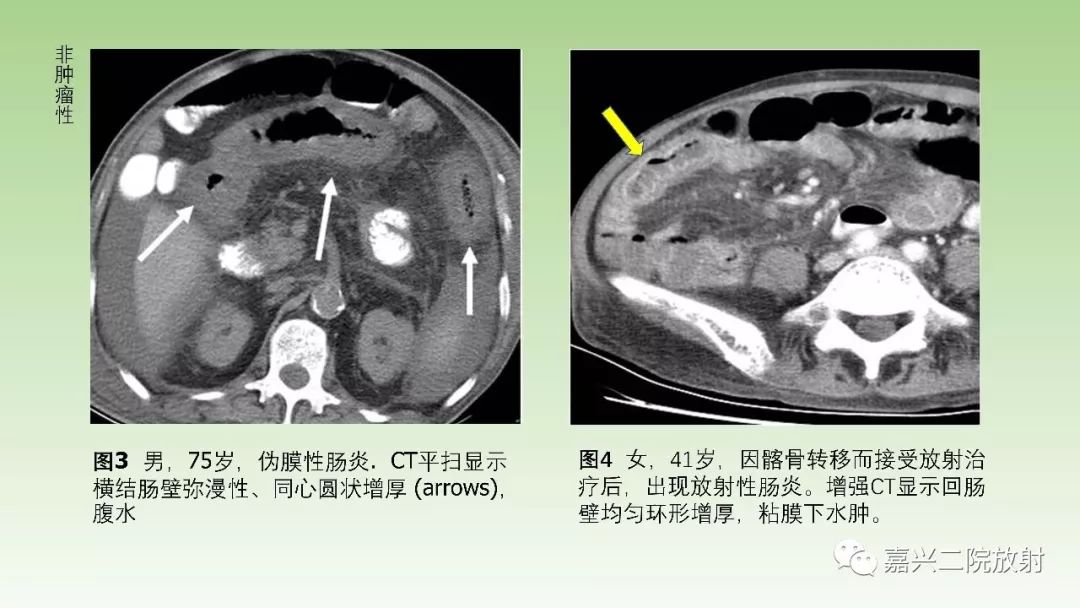 影像PPT - 【PPT】肠壁增厚的CT鉴别诊断-6