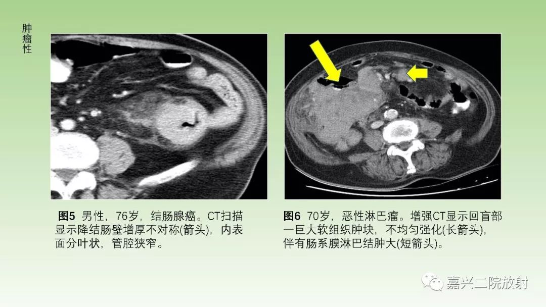 影像PPT - 【PPT】肠壁增厚的CT鉴别诊断-7