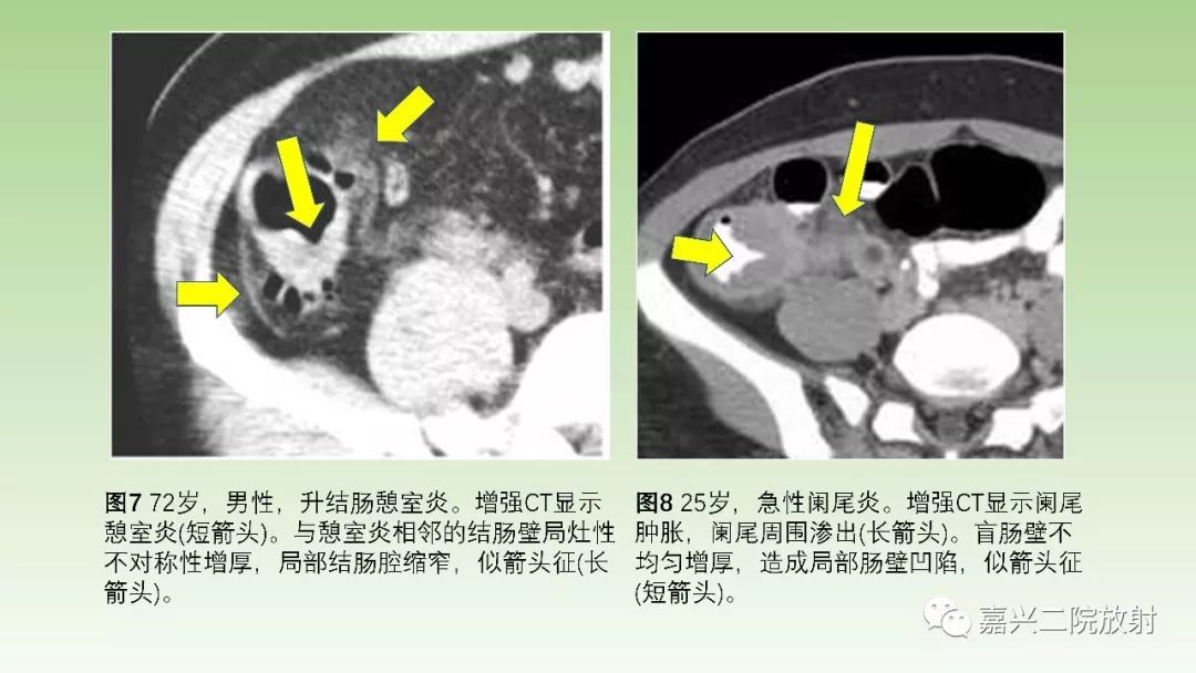 影像PPT - 【PPT】肠壁增厚的CT鉴别诊断-9