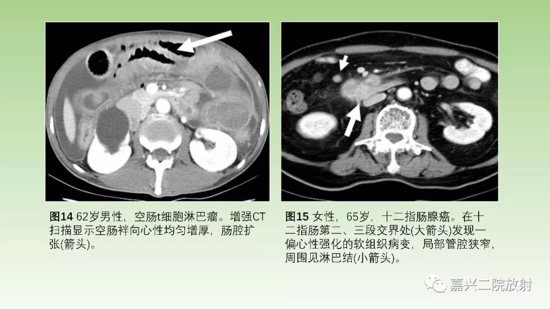 影像PPT - 【PPT】肠壁增厚的CT鉴别诊断-16