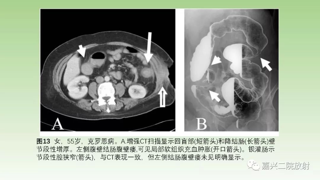 影像PPT - 【PPT】肠壁增厚的CT鉴别诊断-14