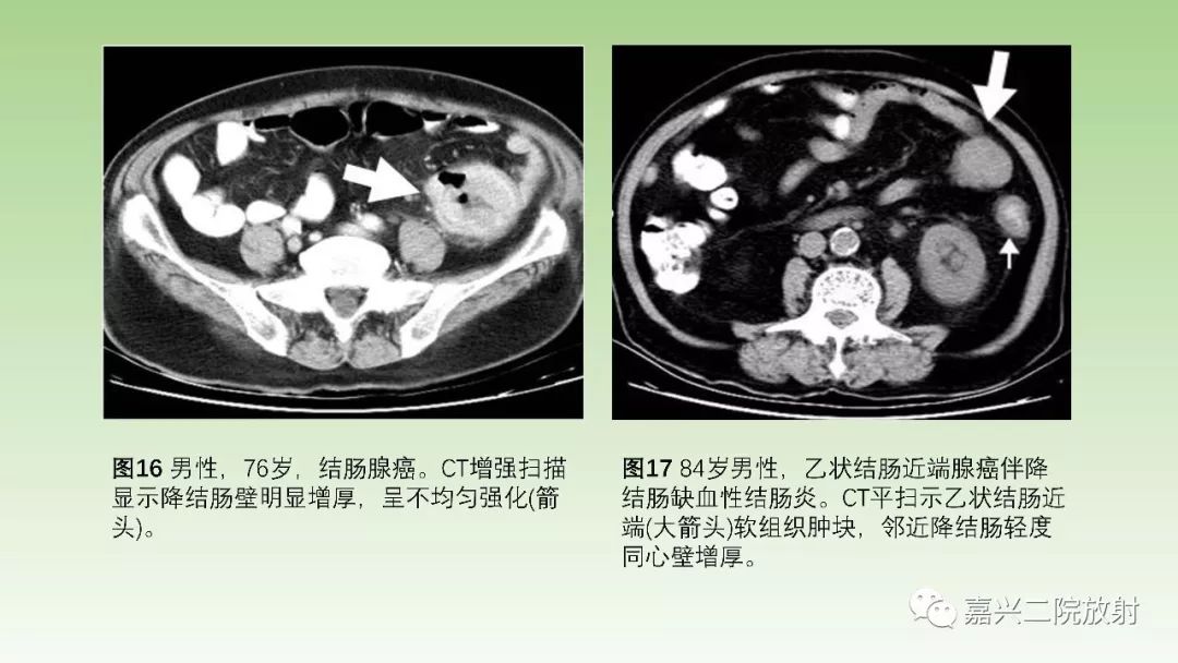 影像PPT - 【PPT】肠壁增厚的CT鉴别诊断-17