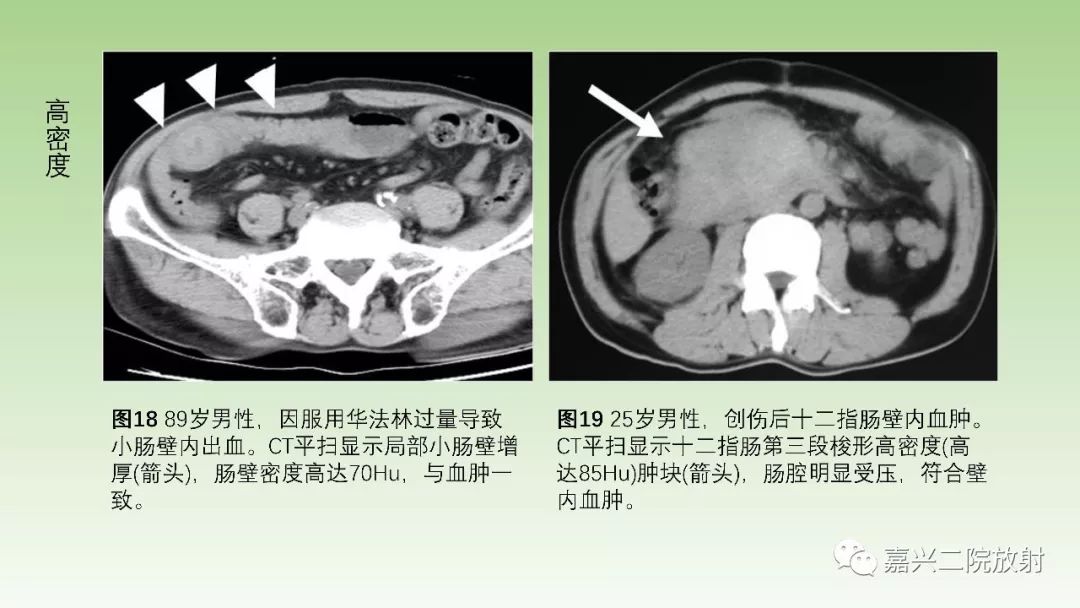 影像PPT - 【PPT】肠壁增厚的CT鉴别诊断-19