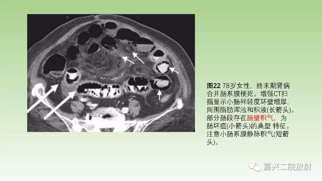 影像PPT - 【PPT】肠壁增厚的CT鉴别诊断-21