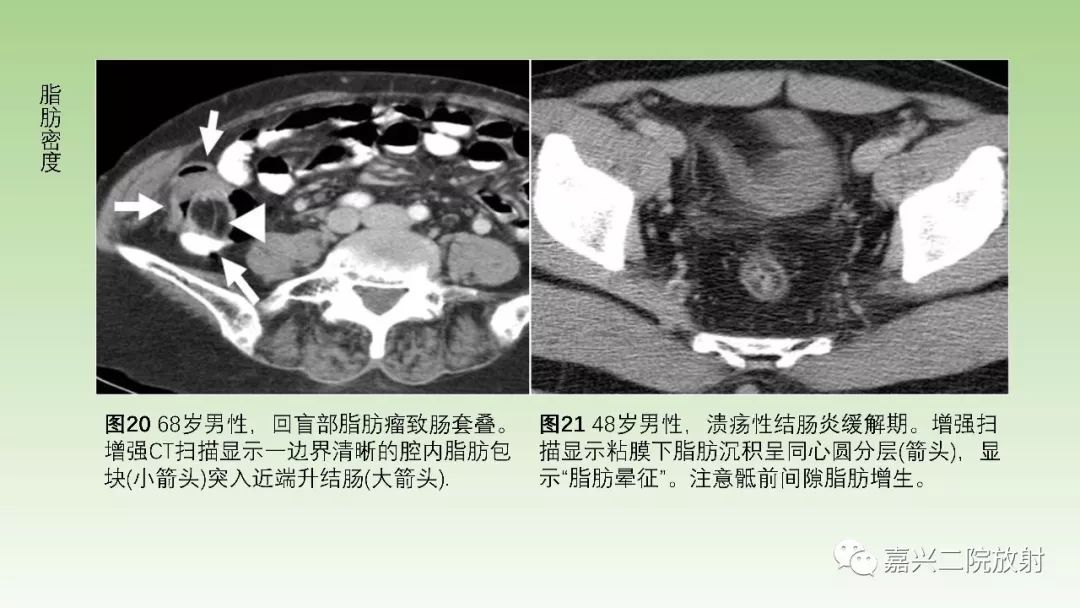 影像PPT - 【PPT】肠壁增厚的CT鉴别诊断-20