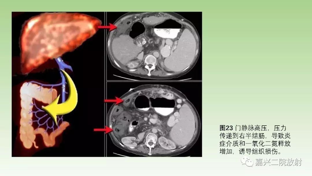 影像PPT - 【PPT】肠壁增厚的CT鉴别诊断-23