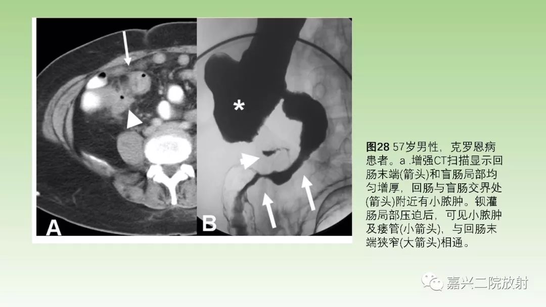 影像PPT - 【PPT】肠壁增厚的CT鉴别诊断-28
