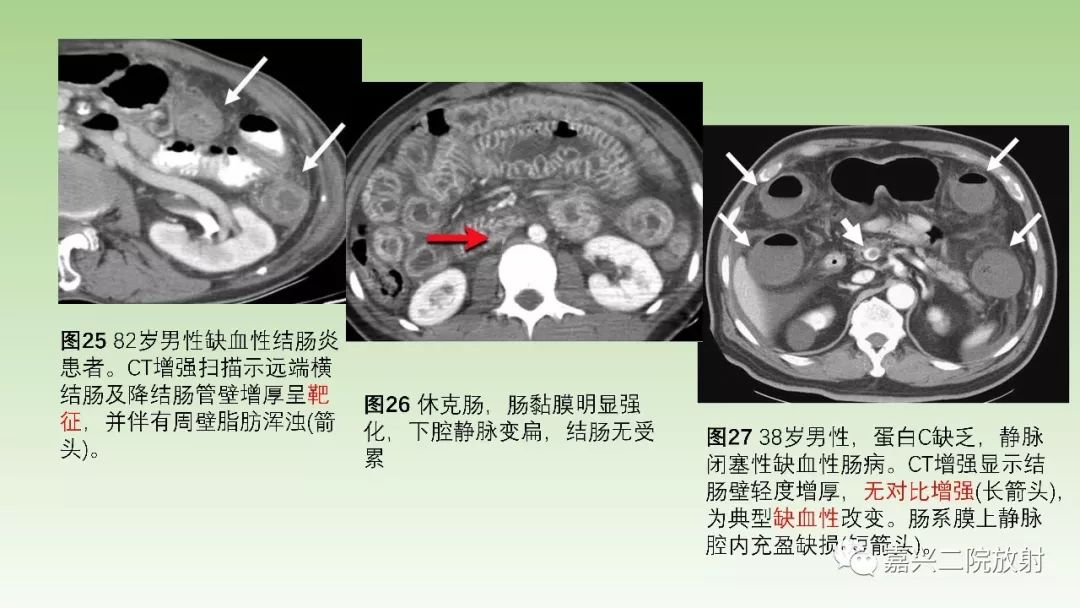 影像PPT - 【PPT】肠壁增厚的CT鉴别诊断-26