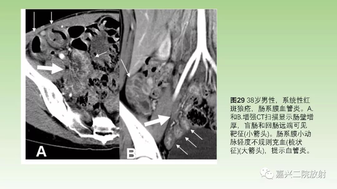影像PPT - 【PPT】肠壁增厚的CT鉴别诊断-29